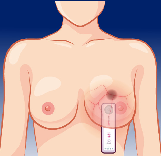 暗い部屋でBREAST-i（ブレスト アイ）を左側乳房下側に当てているラスト